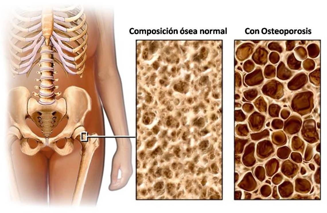 osteoporosis_porosidad_hueso